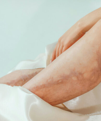 visszerek megelőzése